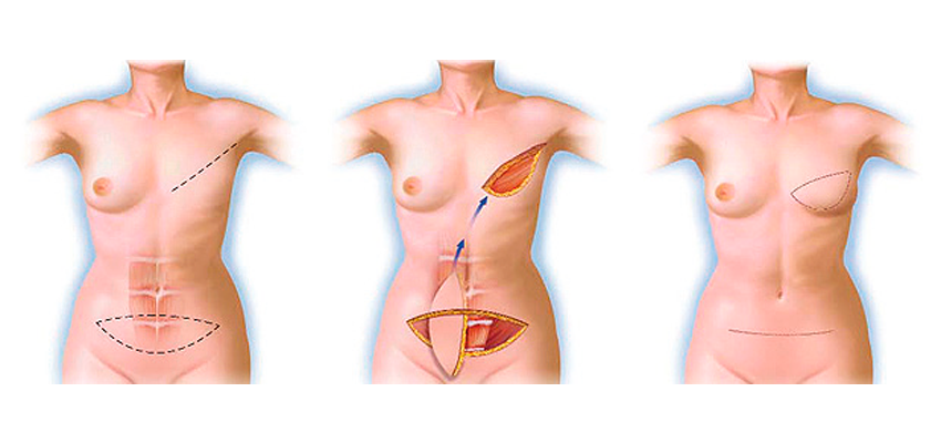 Quando Fazer a Reconstrução Mamária com Retalho do Músculo Reto Abdominal (TRAM)? - Dr. F. Felipe Laitano - Cirurgia Plástica em Porto Alegre