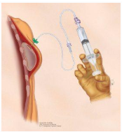 Quando a Reconstrução Mamária com Expansor é Indicada? - Dr. F. Felipe Laitano - Cirurgia Plástica em Porto Alegre